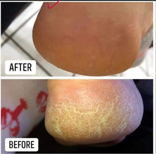 Epoch® Sole Solution® Foot Treatment